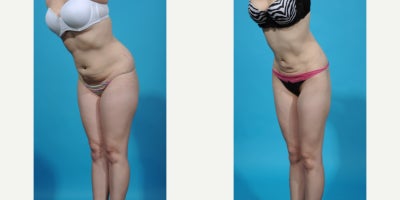 35-44 year old woman treated with Abdominal Etching, Laser Liposuction, Liposculpture, Liposuction, Power-Assisted Liposuction ( - before and after VASER ultrasound assisted liposuction abdomen/flanks; lipo 360. Liposuction is the most popular plastic surgery procedure with about 350,000 procedure done in 2023. Good candidates for liposuction have normal or near normal weight but have discrete problem areas with discrete pockets of fat. Another charateristic of a good liposuction candidate is skin quality. Younger patients with good skin quality and few stretch marks with little to no overhang or excess skin are the best candidates. Vaser is an ultrasound device that melts fat and tightens tissue making liposuction more precise with less bruising and swelling. In this case I did liposuction with VASER assistance removing about 1.5 from her abdomen and flank areas (Lipo 360).