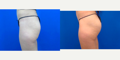 Non-Surgical Butt Lift - Non-Surgical Butt Lift: Improved projection following 24 treatments of acoustic wave therapy