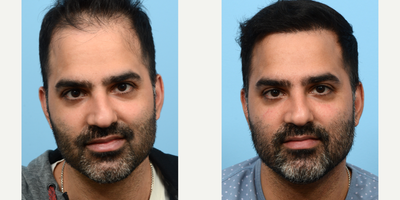 35-44 year old man treated with FUE Hair Transplant, Hair Transplant, Hair Loss Treatment, PRP for Hair Loss, NeoGraft - 36-year-old male was presenting with traditional male pattern baldness. Patient desired hair at his receding hairline and overall increased density. To address increasing the volume of hair to his hairline, NeoGraft, a follicular unit extraction (FUE) was utilized to harvest the hair follicles. The procedure involved a total of 3,040 grafts and one treatment of PRP therapy to further strengthen the follicles.