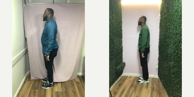 25-34 year old man treated with Endoscopic Sleeve Gastroplasty - he lost 76 LBS in 10 months after his Endoscopic Sleeve Gastroplasty Suture Sculpt weight loss procedure.