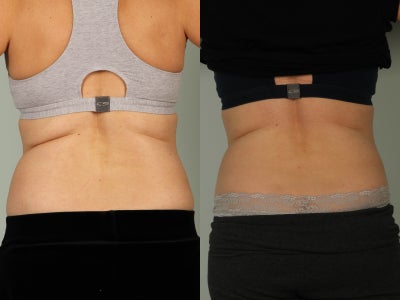 58 year old woman treated with Vanquish - 1 month after series of 5 Vanquish procedures to flanks and abdomen. Patient lost 6 inches at the waist and 4 inches at the umbilicus.
