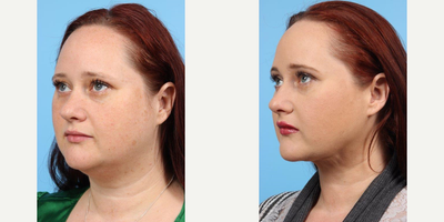 35-44 year old woman treated with Buccal Fat Removal - A 39 year old woman before and after Liposuction Chin and Neck with Platysmaplasty and removal of Buccal Fat by Andrew T.  Lyos M.D., FACS.