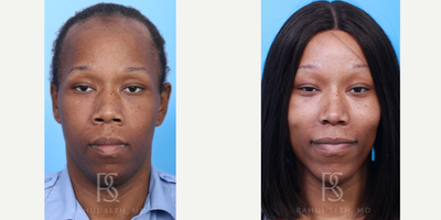 25-34 year old transgender woman treated with Facial Feminization Surgery, Transgender Facial Feminization Surgery, Facial Fat T - Comprehensive facial feminization surgery - browlift, forehead and orbital bone contouring, rhinoplasty, alar base reduction, jaw reduction, chin implant, cheek fat grafting, neck liposuction.