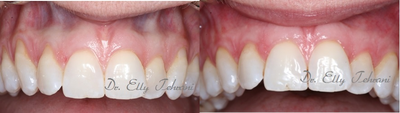 Alloderm Graft - The patient has thin tissue type which caused severe recession and sensitivity on top front teeth.&nbsp; Alldoerm grafting was used to cover exposed roots.