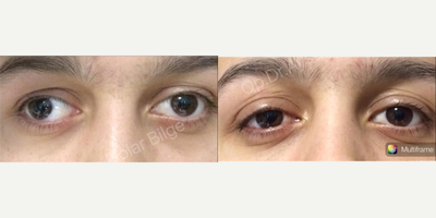 Man treated with Strabismus Surgery - Man treated with Strabismus Surgery