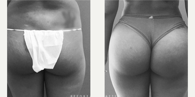 Woman treated with Brazilian Butt Lift - Woman treated with Brazilian Butt Lift as well as Liposuction