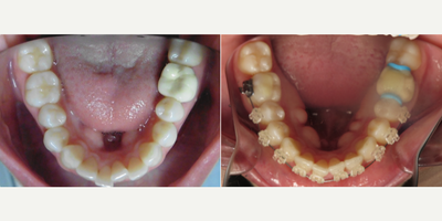 25-34 year old woman treated with AcceleDent - 1 month treatment progress with Acceledent!