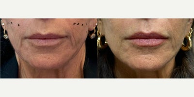Woman treated with Thread Lift, Contour Thread Lift - Woman treated with Thread Lift, Contour Thread Lift