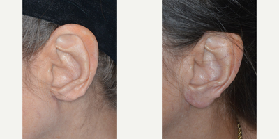 55-64 year old woman treated with Ear Surgery - Complicated case of an earlobe reconstruction for a patient who had undergone previous aggressive earlobe reduction elsewhere and wanted her earlobes restored. Ear cartilage grafting and rotational flap was used to reconstruct the bilateral earlobes.
