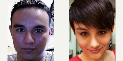 Facial Feminization Surgery - Facial Feminization Surgery