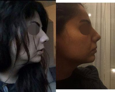 25-34 year old woman treated with Juvederm Nose Job - Nose job with Filler. Immediate result.