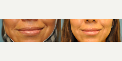 35-44 year old woman treated with Lip Reduction - 37 year old female treated with Lower Lip Reduction