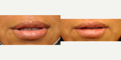 35-44 year old woman treated with Lip Reduction - 37 year old female treated with Lower Lip Reduction