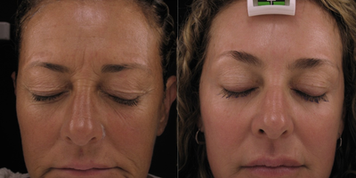 45-54 year old woman treated with Pearl Laser - This patient had dramatic results with her Pearl Laser treatment. She looks years younger.