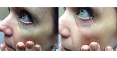 45-54 year old woman treated with Excel V - Vein removal