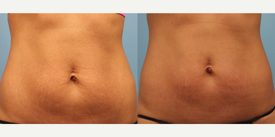 35-44 year old woman treated with Venus Legacy - This client came to our office concerned about skin laxity and stretchmarks on her abdomen and scarring above her umbilicus (navel).
A series of Non-Ablative Laser Resurfacing (1540) treatments was recommended to improve stretchmarks & scar appearance, combined with Venus Legacy to help tighten and firm the loose skin.