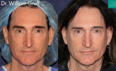 Man treated with Vbeam - CO2, Erbium, Fraxel Dual, Vbeam, and Alexandrite lasers to rejuvenate appearance