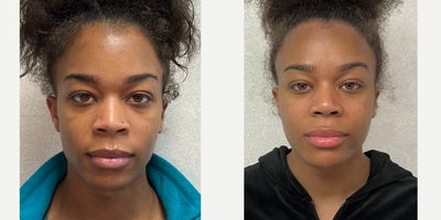 18-24 year old woman treated with African American Rhinoplasty, Rhinoplasty, Septoplasty - this is a young lady who underwent septorhinoplasty.