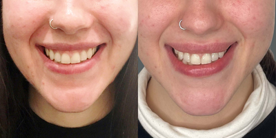25-34 year old woman treated with Botox for Gummy Smile - This is one of our long-standing patients who opted for a Lip Flip rather than Lip Fillers to make her upper lip look subtly fuller and cover the gum of her teeth that appeared when she smiled.