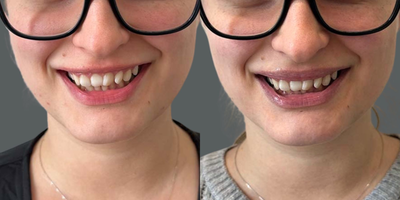 25-34 year old woman treated with Botox for Gummy Smile - This patient did not like how her naturally full upper lip became hidden when she smiled  so our Aesthetic Nurse Prescriber used four micro-injections of Botox on the upper lip to stop her lip from rolling.