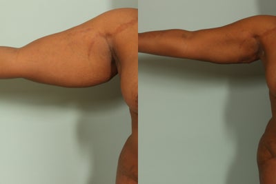 34 Female Interested in arm improvement - 
	34 Female had liposuction of bilateral arms.
