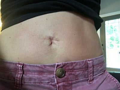complications from tummy tuck belly button