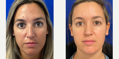 18-24 year old woman treated with IPL - This patient had 3 sessions of IPL to improve her complexion.