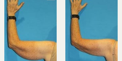 63 year old woman treated with BodyTite - Patient is 63 years old. She lives a very active lifestyle, working out 4 times a week. She is a healthy eater and avoids sugar. Desires tightening and contouring of the arms.