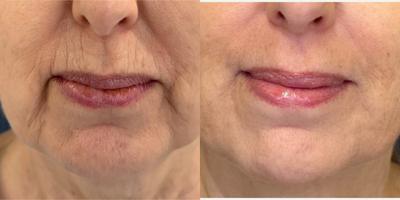 55-64 year old woman treated with Microneedling RF, Microneedling - This 59-year-old patient wanted to address volume loss and the lines around her mouth. She underwent 3 sessions of Genius RF micro needling on the perioral region. The treatments were completed one month apart for three months with a strict skincare regimen of Isdin and Alastin products. The patient is very happy with her results!