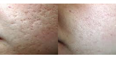35-44 year old man treated with eMatrix - 5 Treatments eMatrix Sublative Skin Resurfacing