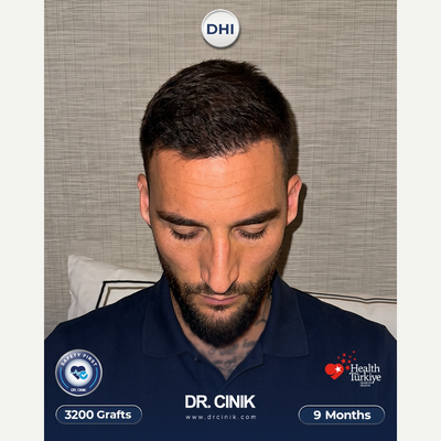 25-34 year old man treated with DHI Hair Transplant - For the well-known football player Nemanja Gudelj, a total of 4700 grafts were transplanted using the DHI technique, with implantation focused on the frontal, mid-scalp, and crown areas to achieve balanced density and natural coverage.