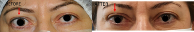 35-44 year old woman treated with Eyelid Retraction Repair - This young woman underwent right upper eyelid retraction surgery because of thyroid eye disease. You can see her results with symmetrical eye appearance.