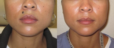 Mole Removal Using Plastic Surgery Techniques - Mole Removal Using Plastic Surgery Techniques