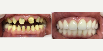 Dental Crowns - Question: When is a dental examination done?Oral and dental health is important in terms of body health, although a dental examination is done when there are any complaints. In this context, dental examination should be undergone at regular intervals. If routine dental check-ups are neglected, many diseases, especially dental decays, occur.Question: When is the first dental examination in children performed?In children, it is necessary to take them to the dental examination for the first time when the tooth comes out. It is necessary for dental health to check milk teeth by a dentist. Depending on whether there is any problem, the dentist will guide about when to go for a check-up.Question: What is Oral Diagnosis?Oral diagnosis is the branch that examines the diagnosis and treatment criteria of diseases related to the mouth, teeth and gums. Developmental defects and anomalies are also covered by this area.Oral diagnosis is divided into two main groups as intraoral and extraoral diagnosis. Basic scientific studies are handled in four groups.Description of symptomsDescription of syndromesDiagnostic methodsDetermination of laboratory  radiological  pathological applications leading to the diagnosisQuestion: How Is Tooth Filling Made?After the tooth tissue is prepared for filling, the teeth cavities are cleaned. After this process, the appropriate material is selected according to the function of the tooth in the mouth. Local anesthesia is required so that the patient does not feel any pain while the filling is being performed. In the last stage, it is checked whether the filling is compatible with the teeth.Question: Impacted teeth should be extracted in certain situations. These situations can be listed as follows;Presence of semi-impacted teeth that have caused gum infectionPresence of teeth that compress adjacent teeth and cause painRisk of cyst formation around the impacted toothOrthodontic reasonsQuestion: How long is the life of tooth with a root canal treatment?The root canal treated tooth can stay with you for a lifetime if the necessary sensitivity is shown by giving importance to oral and dental hygiene, not disrupting the doctors controls.