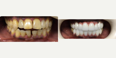 Dental Crowns - Question: When is a dental examination done?Oral and dental health is important in terms of body health, although a dental examination is done when there are any complaints. In this context, dental examination should be undergone at regular intervals. If routine dental check-ups are neglected, many diseases, especially dental decays, occur.Question: When is the first dental examination in children performed?In children, it is necessary to take them to the dental examination for the first time when the tooth comes out. It is necessary for dental health to check milk teeth by a dentist. Depending on whether there is any problem, the dentist will guide about when to go for a check-up.Question: What is Oral Diagnosis?Oral diagnosis is the branch that examines the diagnosis and treatment criteria of diseases related to the mouth, teeth and gums. Developmental defects and anomalies are also covered by this area.Oral diagnosis is divided into two main groups as intraoral and extraoral diagnosis. Basic scientific studies are handled in four groups.Description of symptomsDescription of syndromesDiagnostic methodsDetermination of laboratory  radiological  pathological applications leading to the diagnosisQuestion: How Is Tooth Filling Made?After the tooth tissue is prepared for filling, the teeth cavities are cleaned. After this process, the appropriate material is selected according to the function of the tooth in the mouth. Local anesthesia is required so that the patient does not feel any pain while the filling is being performed. In the last stage, it is checked whether the filling is compatible with the teeth.Question: Impacted teeth should be extracted in certain situations. These situations can be listed as follows;Presence of semi-impacted teeth that have caused gum infectionPresence of teeth that compress adjacent teeth and cause painRisk of cyst formation around the impacted toothOrthodontic reasonsQuestion: How long is the life of tooth with a root canal treatment?The root canal treated tooth can stay with you for a lifetime if the necessary sensitivity is shown by giving importance to oral and dental hygiene, not disrupting the doctors controls.