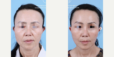 Woman treated with Facelift, Brow Lift, Facial Fat Transfer - The best part of this transformation? It simply looks like she went back in time without obvious tell tale signs of cosmetic surgery!This female patient underwent a Facelift, Endoscopic Brow Lift, Lower Blepharoplasty & Fat Transfer to Face. Shes currently 4 months post-op & beautifully healing When addressing the face to gain a youthful appearance, a multitude of procedures are highly recommended to achieve harmonious & balanced results.