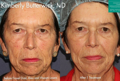 Woman treated with Vbeam - Fraxel, Alexandrite, Vbeam lasers to treat sun damage on face.