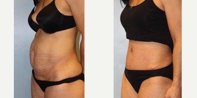 25-34 year old woman treated with Tummy Tuck - 2 months after Tummy tuck surgery performed by Dr. Bryson Richards.