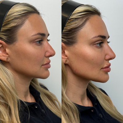 35-44 year old woman treated with Renuva - Renuva is a bio stimulator injectable that restores youthful volume by replacing age-related fat loss with your bodys own natural fat cells. Renuva works by stimulating your body to grow new fat where its needed, whether thats smoothing hollow areas, softening lines, or restoring contours. The result is natural-looking rejuvenation that blends seamlessly with your own tissue, without the need for surgery.