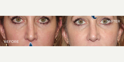 Woman treated with Rhinoplasty - Woman treated with Rhinoplasty