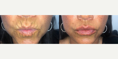 Woman treated with Restylane Refyne - Woman treated with Restylane Refyne
