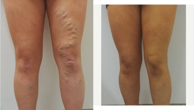 18-24 year old woman treated with EVLT - Severe varicose veins left leg. Patient was very conscious of image and leg ached.