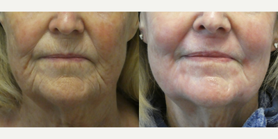 65-74 year old woman treated with ProFractional Laser - Patient is a 70 year old woman who came to us complaining of the lines around her mouth. Ashley Ackerson did one laser treatment of full field contourTRL perioral resurfacing and profractional with the Sciton laser. Results are 2 weeks post 1 treatment. Patient is still a little pink but will continue to improve with time. Usually redness subsides within 6 weeks.