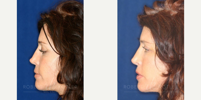 Permanent Non-surgical Revision Rhinoplasty - Restoration to natural tip and correction of depressed bridge resulting in a nose that no longer appears over operated.