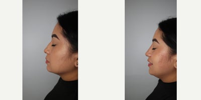 35-44 year old woman treated with Nonsurgical Nose Job - Non surgical nose job before and after