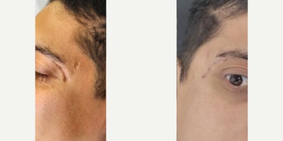 35-44 year old man treated with Scar Removal - Scar revision 1 month after
