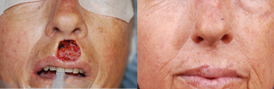 Repair of upper lip Mohs defect - Upper lip repaired with skin graft and advancement flap.