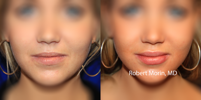 18-24 year old woman treated with Lip Augmentation - Juvederm lip augmentation