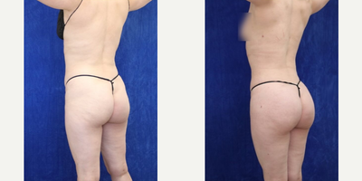 Woman treated with Brazilian Butt Lift, Renuvion, Vaser Liposuction - Woman treated with Brazilian Butt Lift, Renuvion, Vaser Liposuction