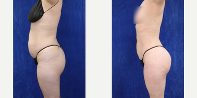 Woman treated with Brazilian Butt Lift, Renuvion, Vaser Liposuction - Woman treated with Brazilian Butt Lift, Renuvion, Vaser Liposuction